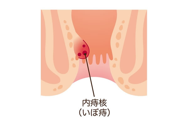 内痔核
