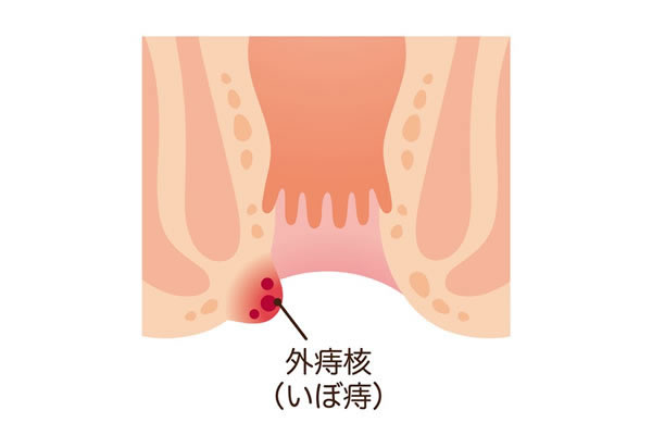 外痔核