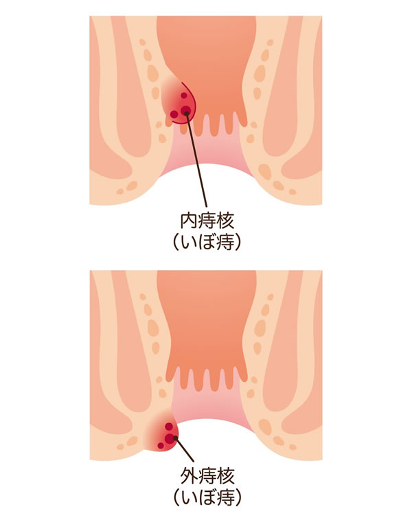 いぼ痔(痔核)