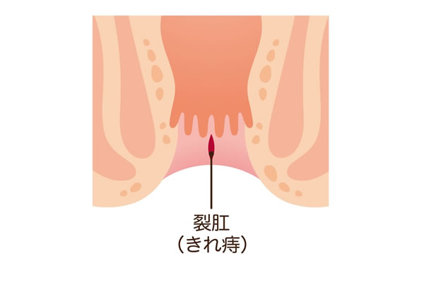 切れ痔(裂肛)