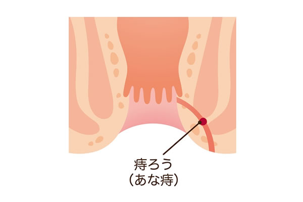 あな痔（痔ろう）